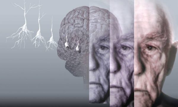 Alzheimer Hastalığı ve Demans Arasındaki Farklar