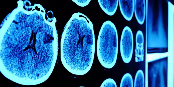 D Vitamini Eksikliği Beyni Nasıl Etkiliyor?