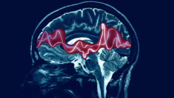 Dirençli Epilepsi Nedir, Nasıl Tedavi Edilir?